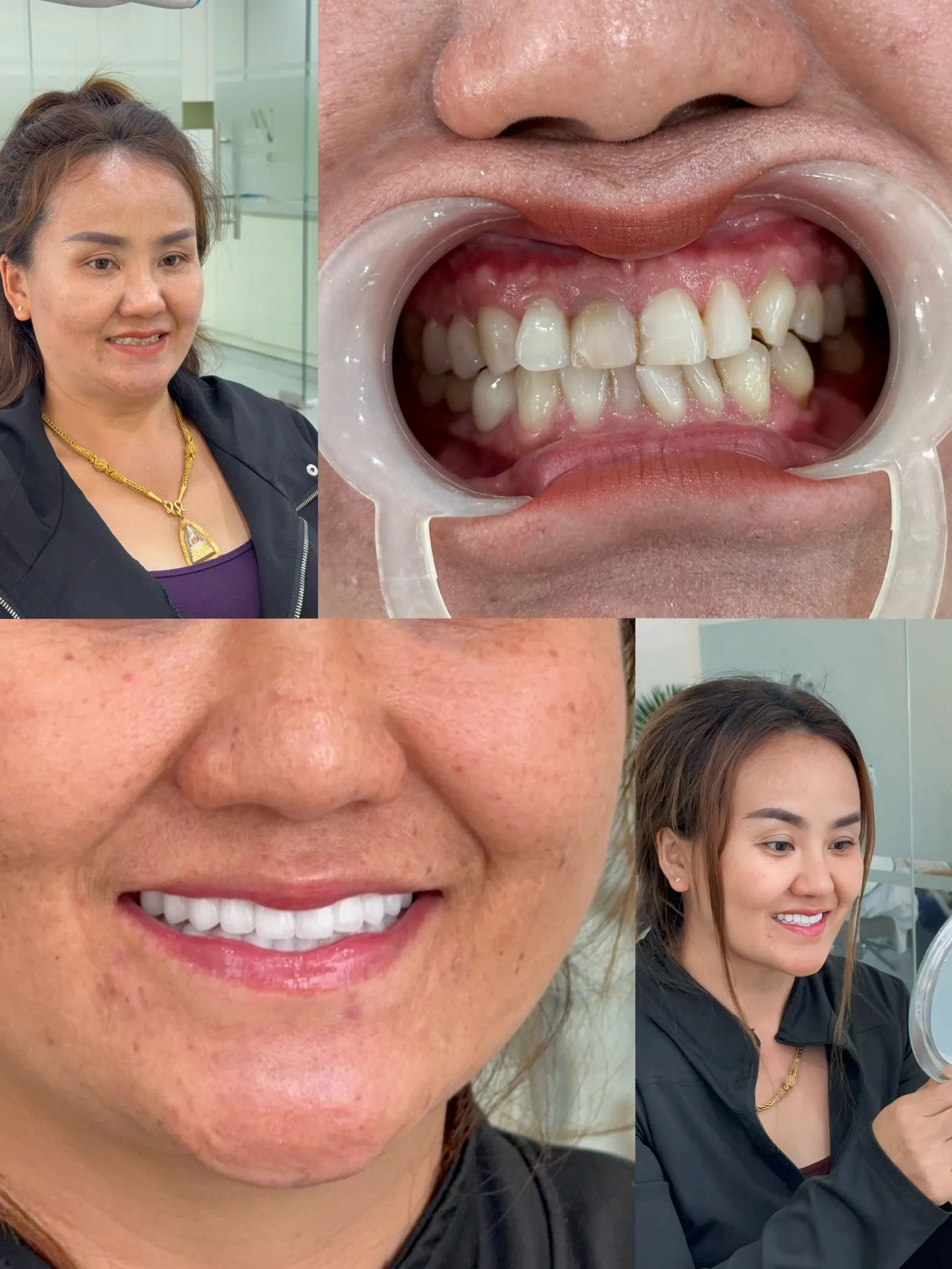 Eating comfortably with restored teeth Before
