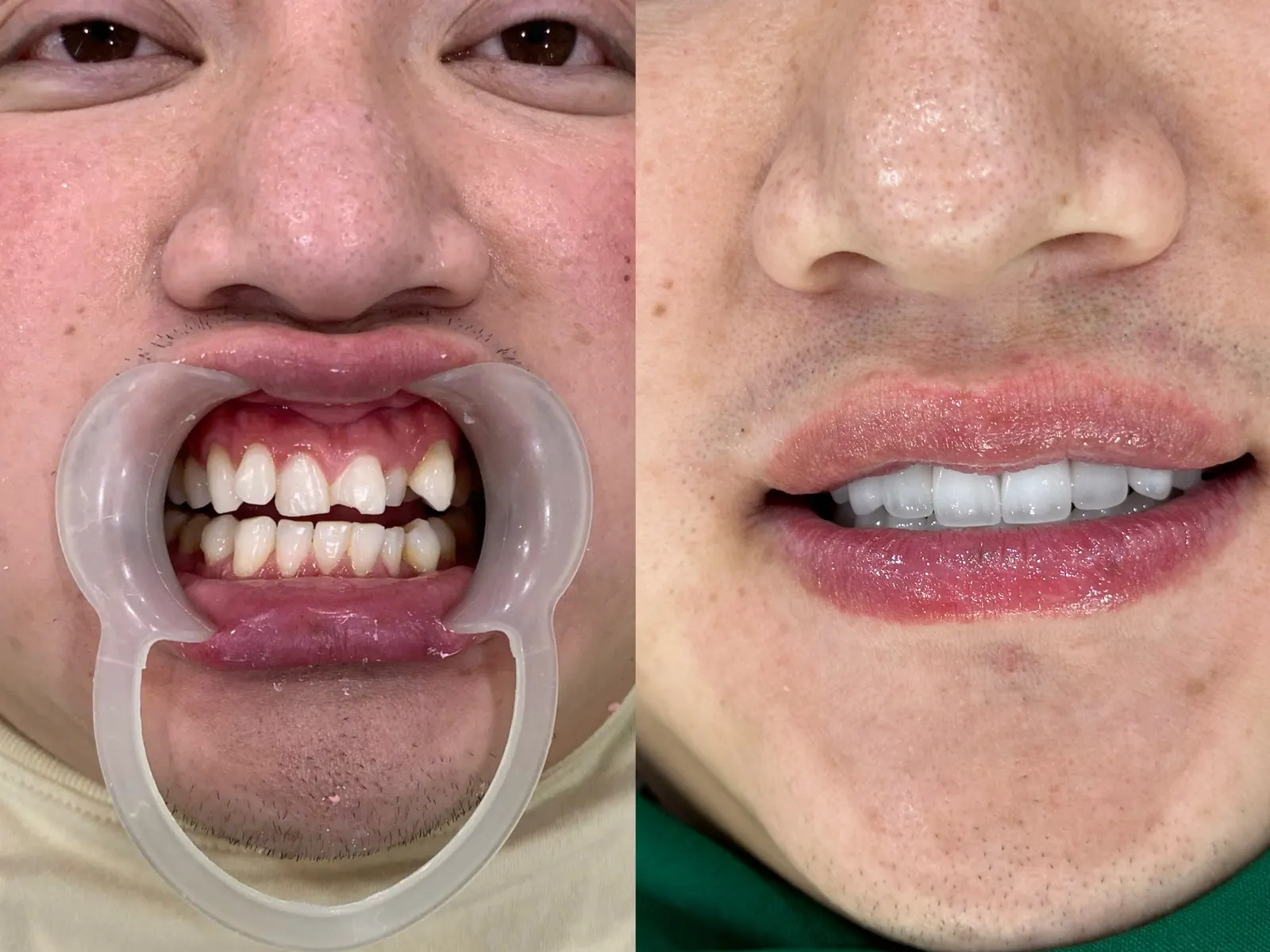 A brighter smile with a natural look After